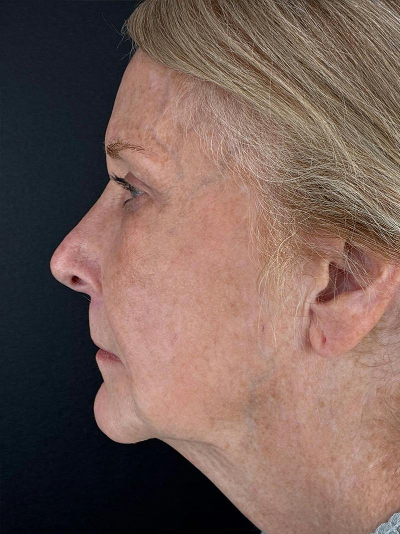 Neck Lift Before & After Gallery - Patient 296854 - Image 5