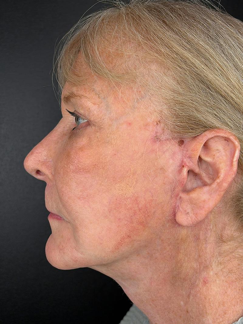 Neck Lift Before & After Gallery - Patient 296854 - Image 6