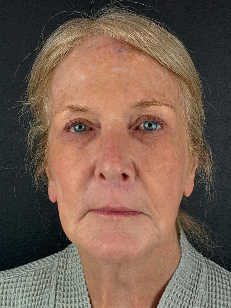 Neck Lift Before & After Gallery - Patient 296854 - Image 1