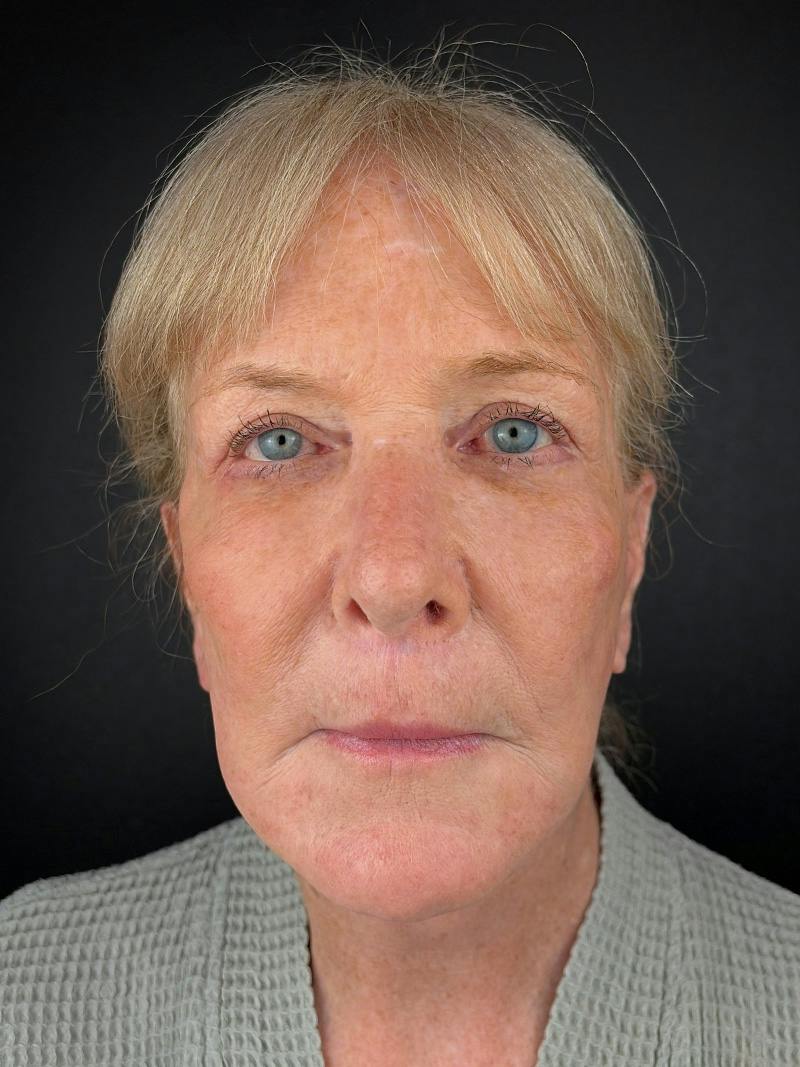 Neck Lift Before & After Gallery - Patient 296854 - Image 2