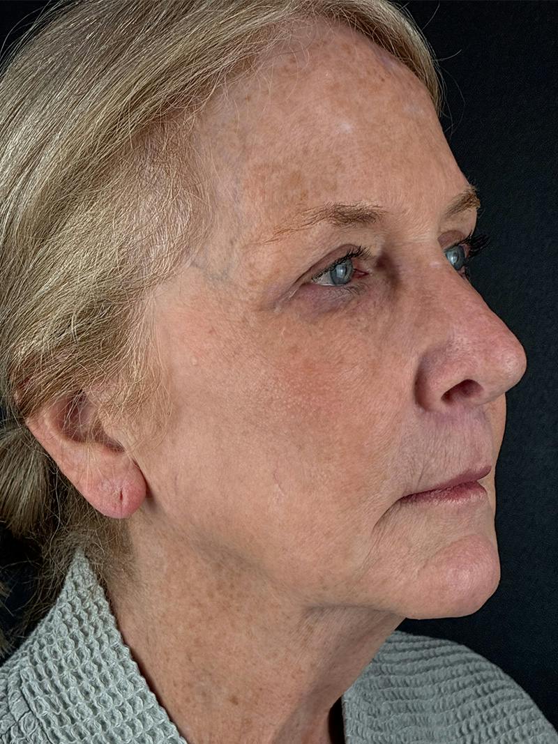 Neck Lift Before & After Gallery - Patient 296854 - Image 3