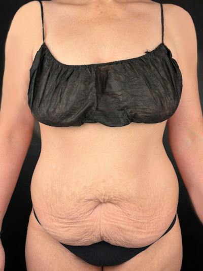Tummy Tuck Before & After Gallery - Patient 425977 - Image 1