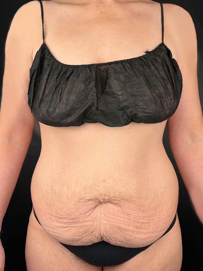 Tummy Tuck Before & After Gallery - Patient 425977 - Image 1