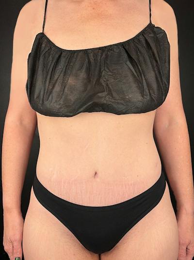 Tummy Tuck Before & After Gallery - Patient 425977 - Image 2