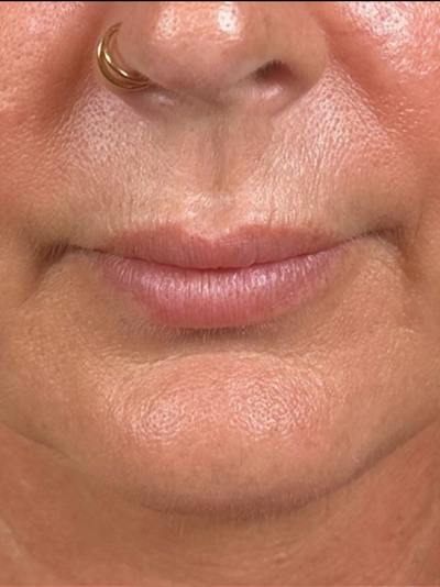 Lip Filler Before & After Gallery - Patient 203620 - Image 1