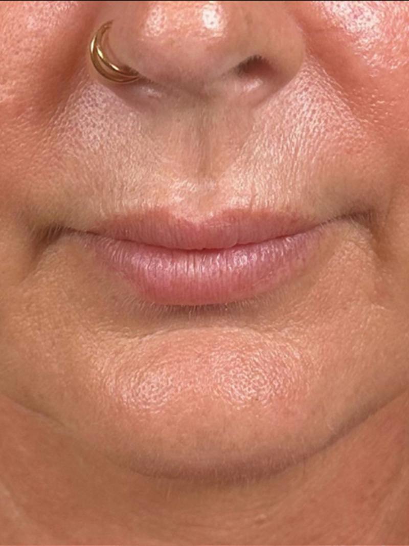 Lip Filler Before & After Gallery - Patient 203620 - Image 1