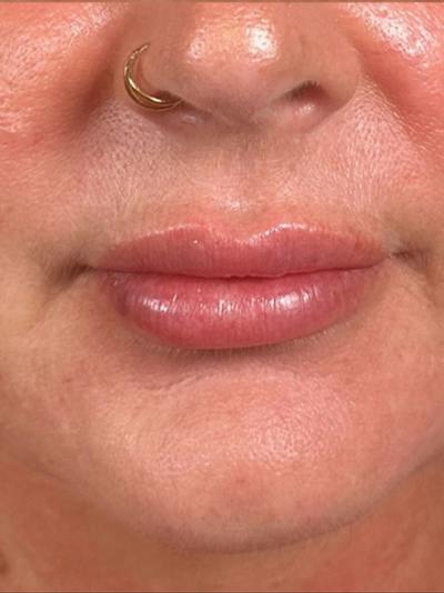 Lip Filler Before & After Gallery - Patient 203620 - Image 2