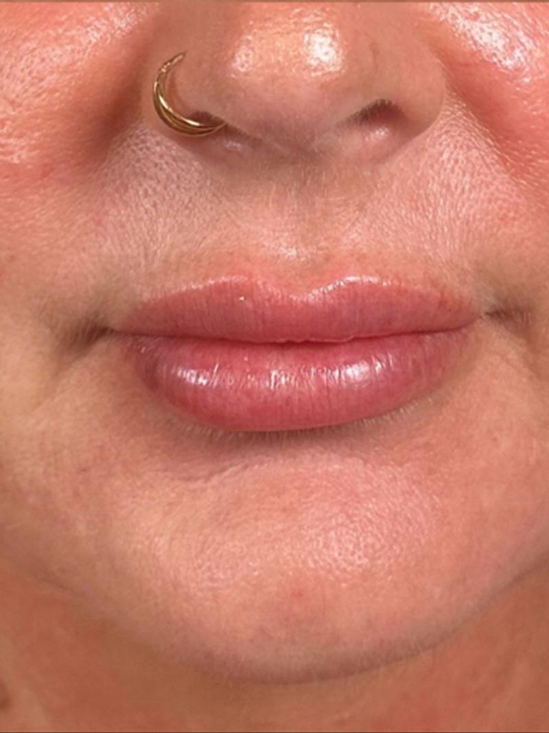Lip Filler Before & After Gallery - Patient 203620 - Image 2