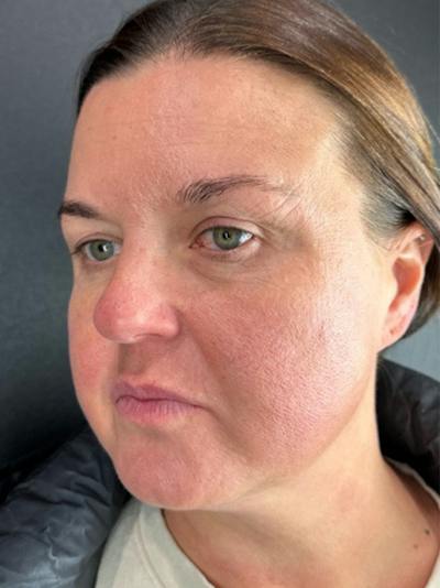 Lower Face Filler Before & After Gallery - Patient 260165 - Image 1