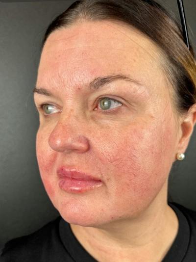 Lower Face Filler Before & After Gallery - Patient 260165 - Image 2
