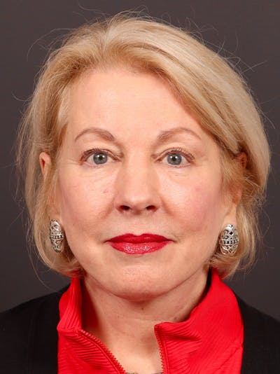 Facelift Before & After Gallery - Patient 119611 - Image 2