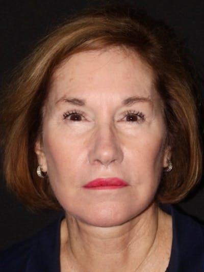 Facelift Before & After Gallery - Patient 349569 - Image 2