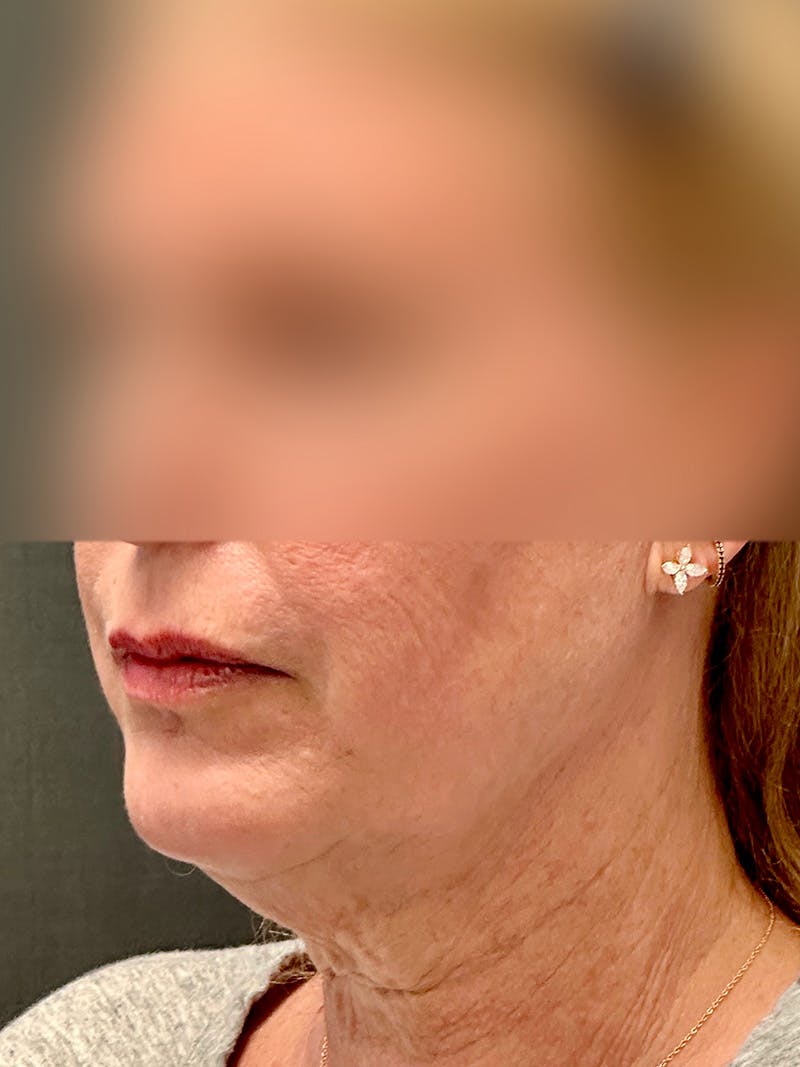 Facelift Before & After Gallery - Patient 355862 - Image 3