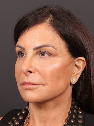 Neck Lift Before & After Gallery - Patient 362491 - Image 4