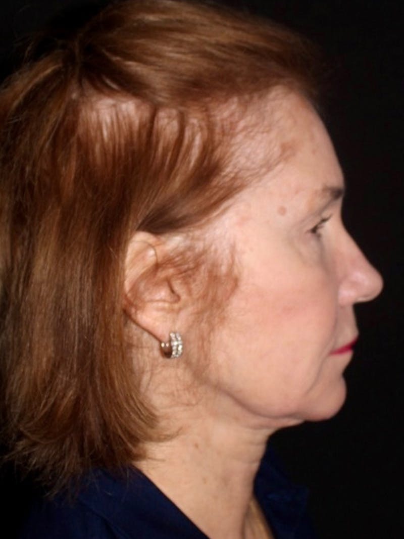 Facelift Before & After Gallery - Patient 349569 - Image 5