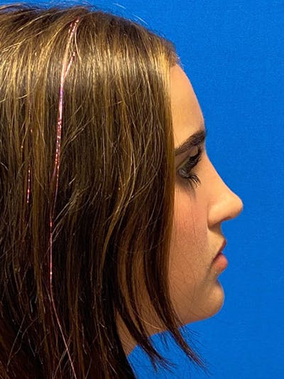Primary Rhinoplasty Before & After Gallery - Patient 401318 - Image 2