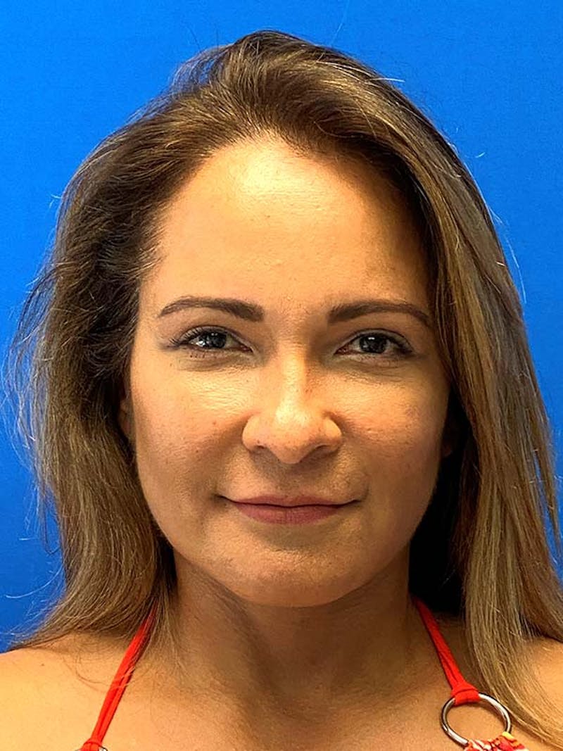 Facelift Before & After Gallery - Patient 181295 - Image 2