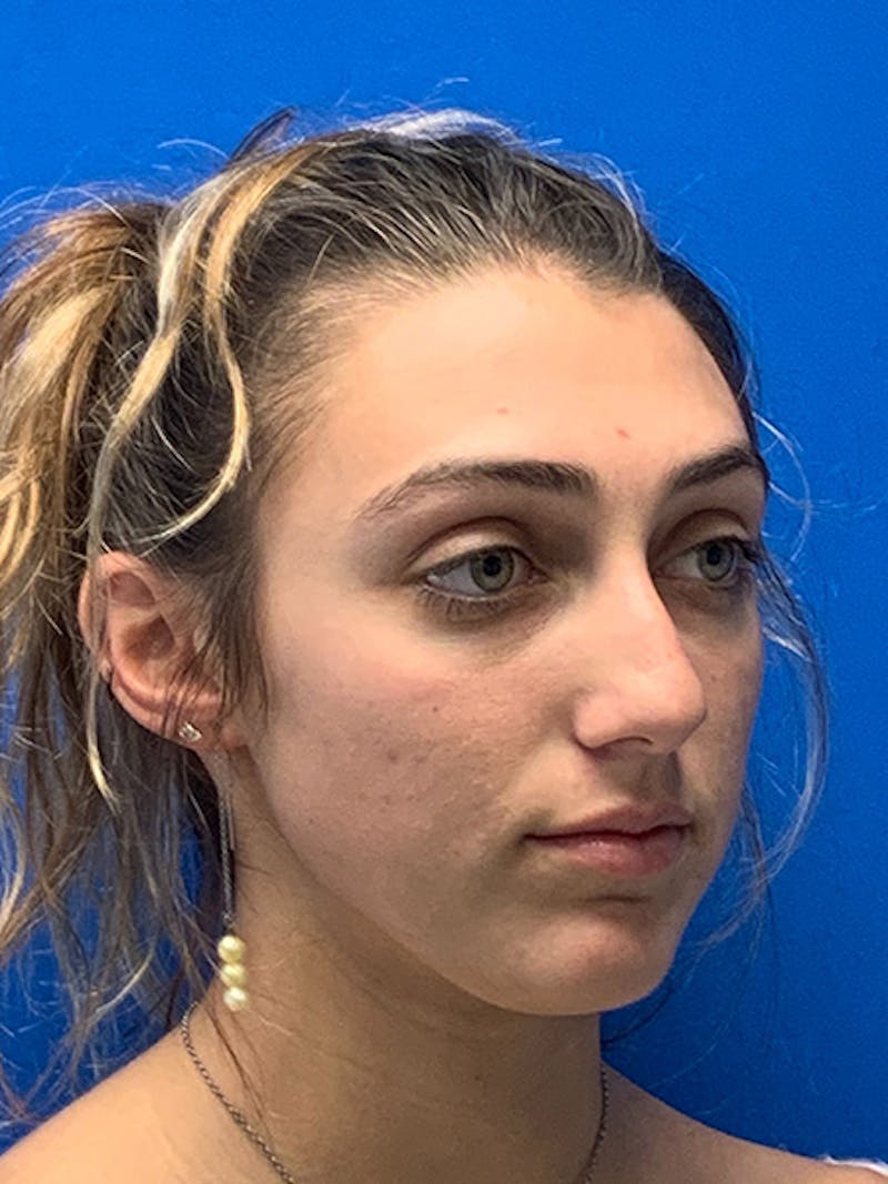 Primary Rhinoplasty Before & After Gallery - Patient 286346 - Image 5