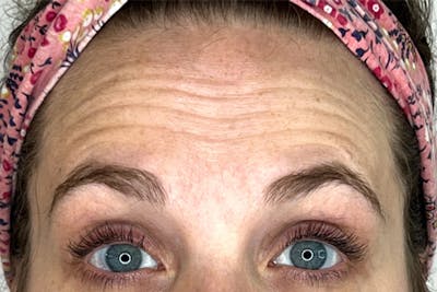 BOTOX Before & After Gallery - Patient 283220 - Image 1