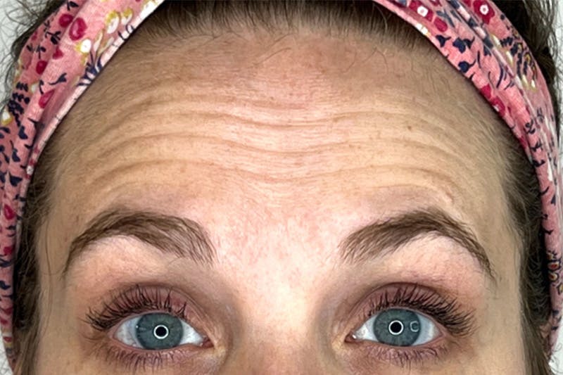 BOTOX Before & After Gallery - Patient 283220 - Image 1