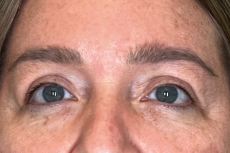 BOTOX Before & After Gallery - Patient 165391 - Image 1