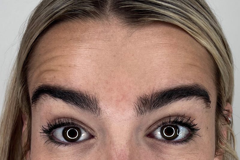 BOTOX Before & After Gallery - Patient 356623 - Image 1