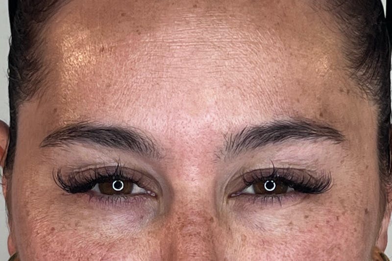 BOTOX Before & After Gallery - Patient 105783 - Image 4
