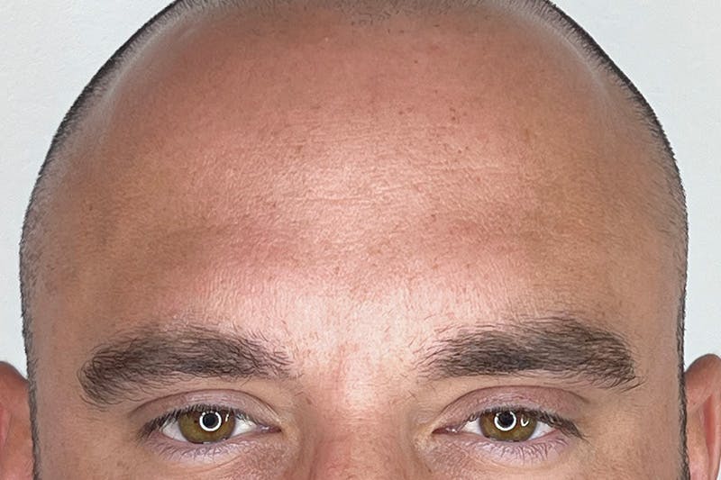BOTOX Before & After Gallery - Patient 295976 - Image 4