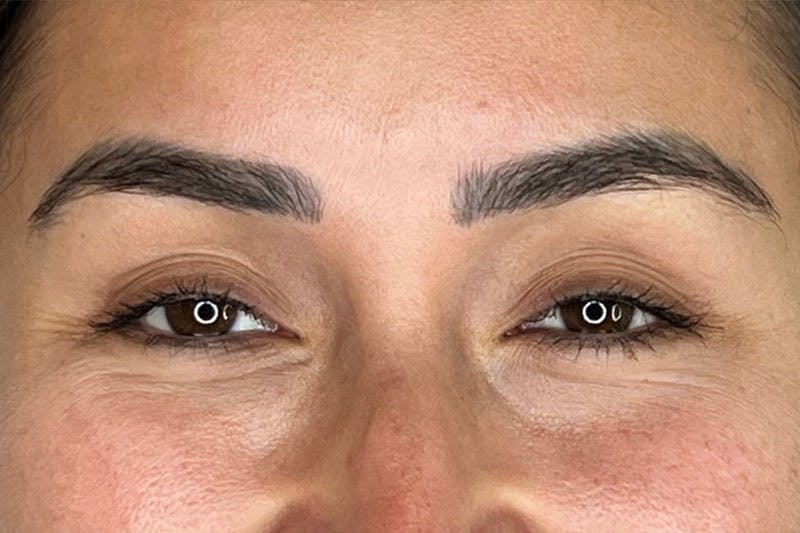 BOTOX Before & After Gallery - Patient 344438 - Image 5