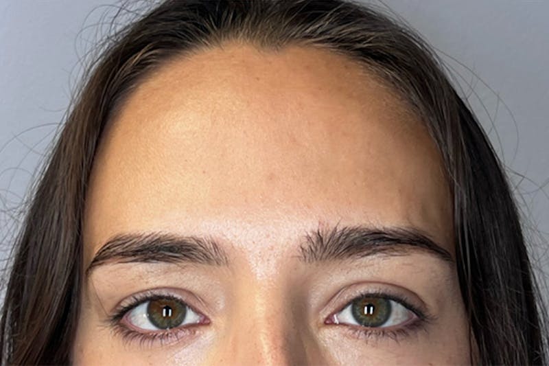 BOTOX Before & After Gallery - Patient 983773 - Image 6
