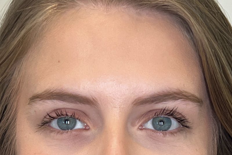 BOTOX Before & After Gallery - Patient 913658 - Image 6