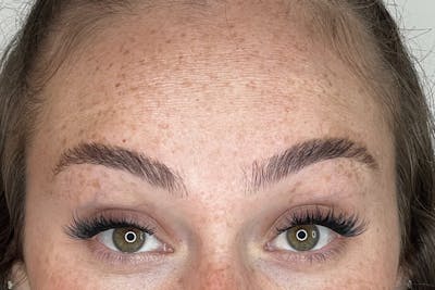 BOTOX Before & After Gallery - Patient 227379 - Image 2