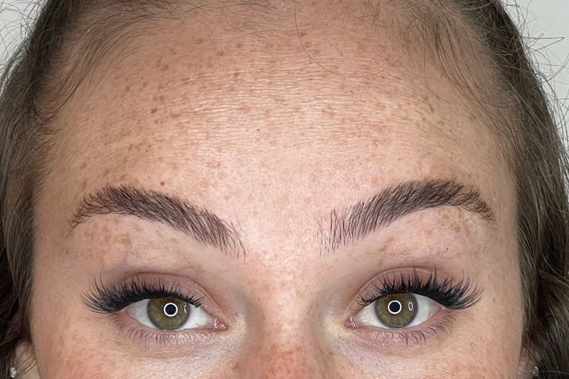 BOTOX Before & After Gallery - Patient 227379 - Image 2