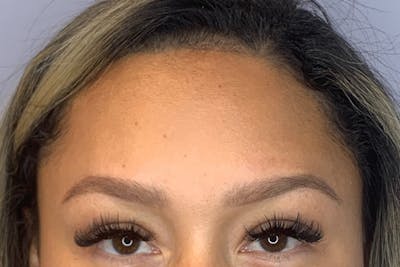BOTOX Before & After Gallery - Patient 175021 - Image 2