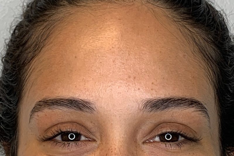 BOTOX Before & After Gallery - Patient 246260 - Image 4