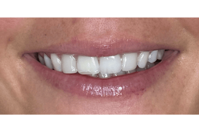 BOTOX Before & After Gallery - Patient 352728 - Image 2