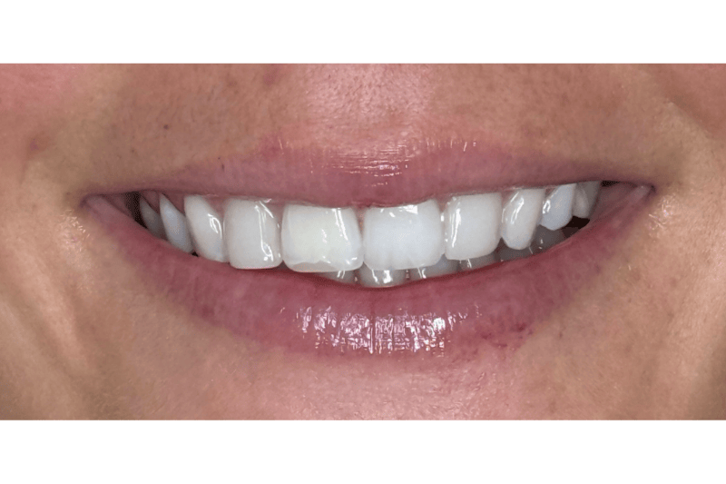BOTOX Before & After Gallery - Patient 352728 - Image 2