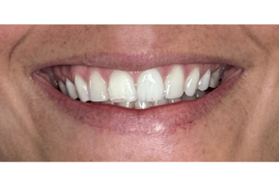 BOTOX Before & After Gallery - Patient 352728 - Image 1