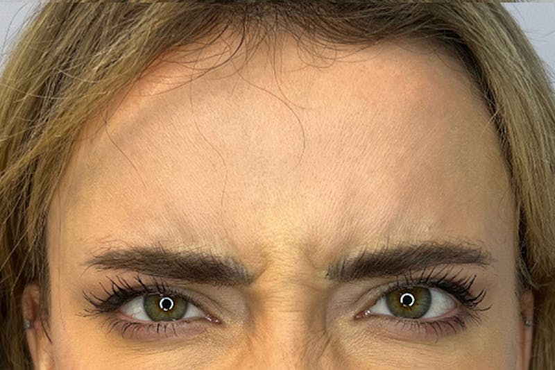 BOTOX Before & After Gallery - Patient 236004 - Image 3