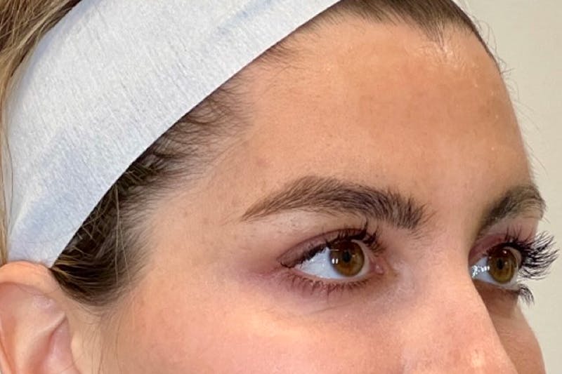 BOTOX Before & After Gallery - Patient 344936 - Image 2