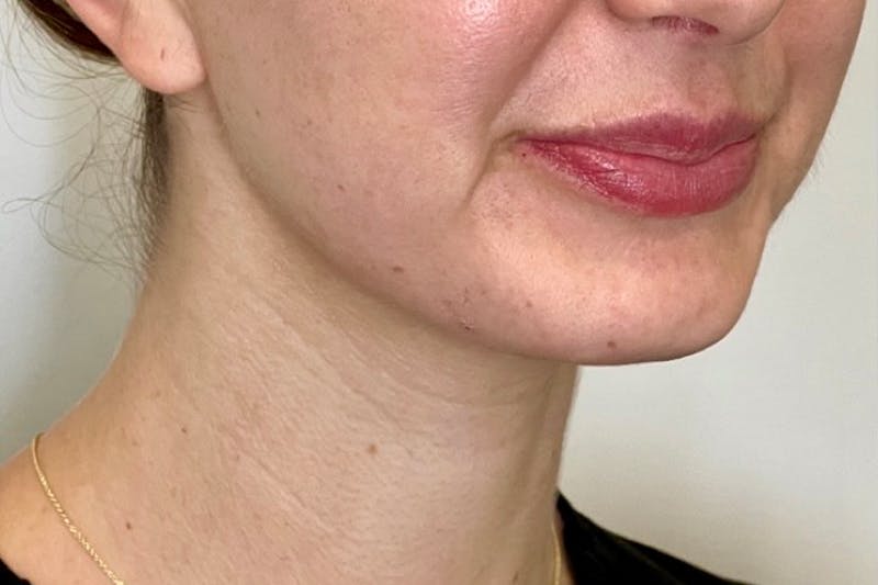 BOTOX Before & After Gallery - Patient 344936 - Image 3