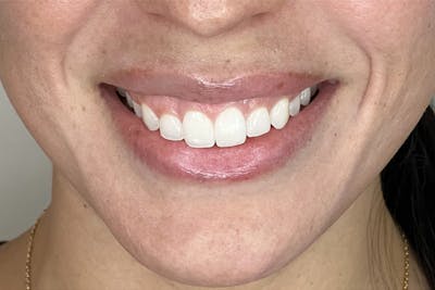 BOTOX Before & After Gallery - Patient 321406 - Image 1