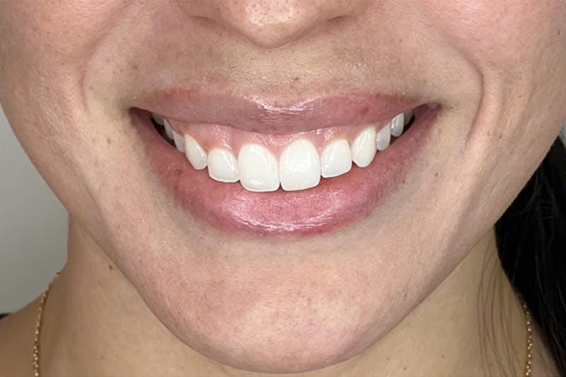 BOTOX Before & After Gallery - Patient 321406 - Image 1