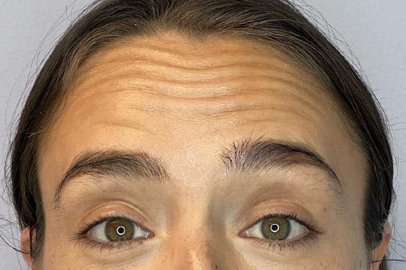BOTOX Before & After Gallery - Patient 983773 - Image 1