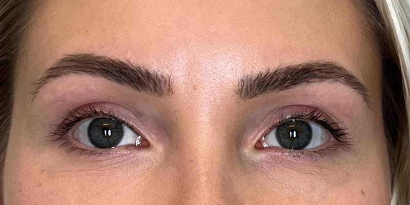 BOTOX Before & After Gallery - Patient 228341 - Image 3