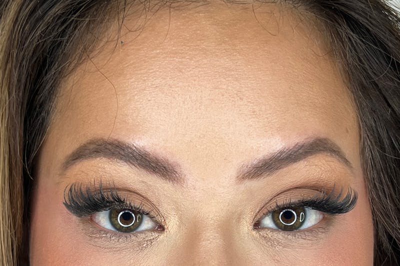 BOTOX Before & After Gallery - Patient 491781 - Image 2