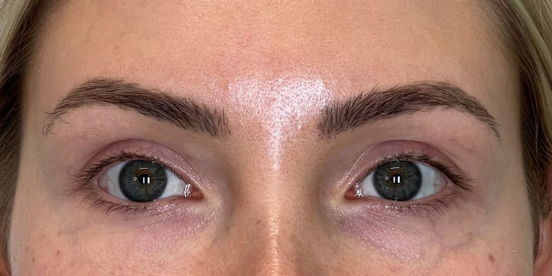 BOTOX Before & After Gallery - Patient 228341 - Image 4
