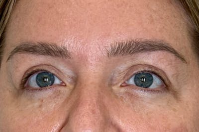 BOTOX Before & After Gallery - Patient 165391 - Image 2