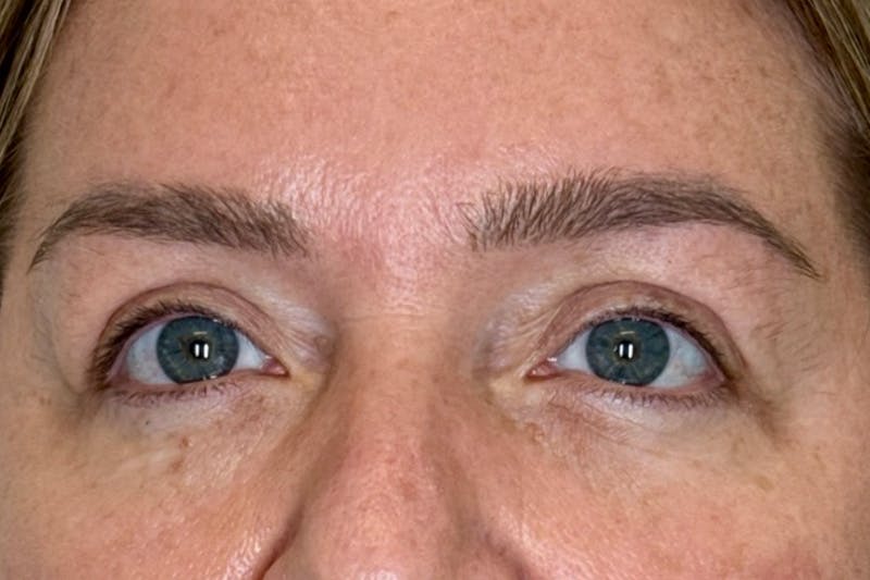 BOTOX Before & After Gallery - Patient 165391 - Image 2
