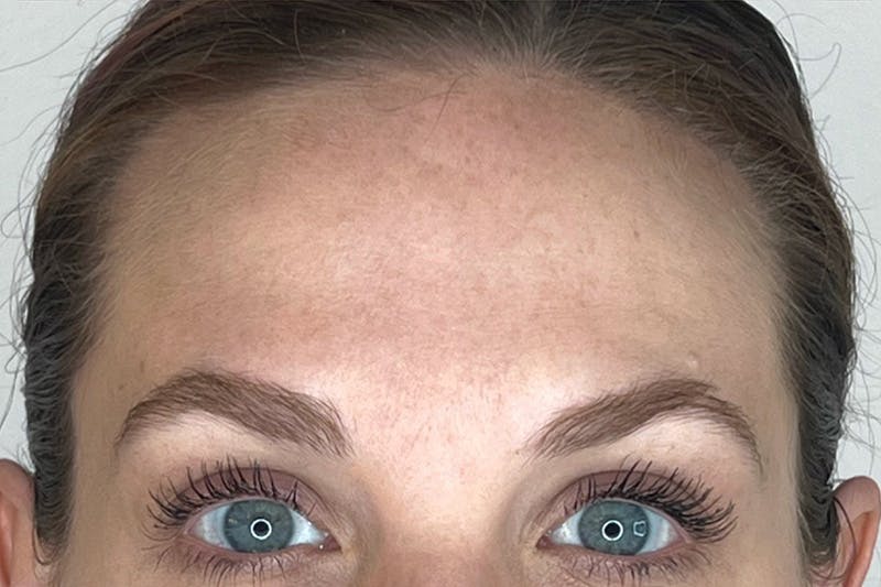 BOTOX Before & After Gallery - Patient 283220 - Image 2